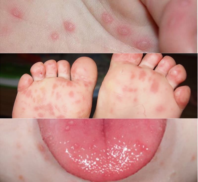 Xuất hiện những dấu hiệu này khi mắc tay chân miệng, cần đến bệnh viện ngay