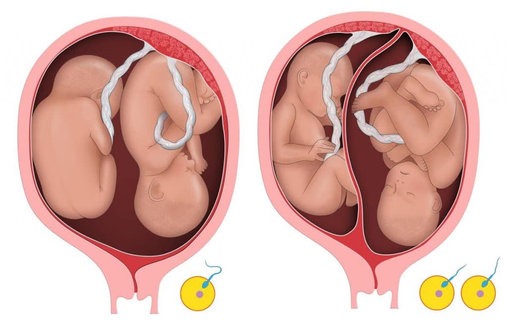 Đa thai là gì và những điều cơ bản mẹ cần biết để sinh con an toàn