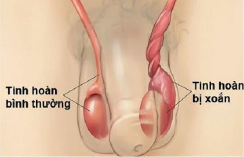  Nam giới chớ chủ quan với xoắn tinh hoàn