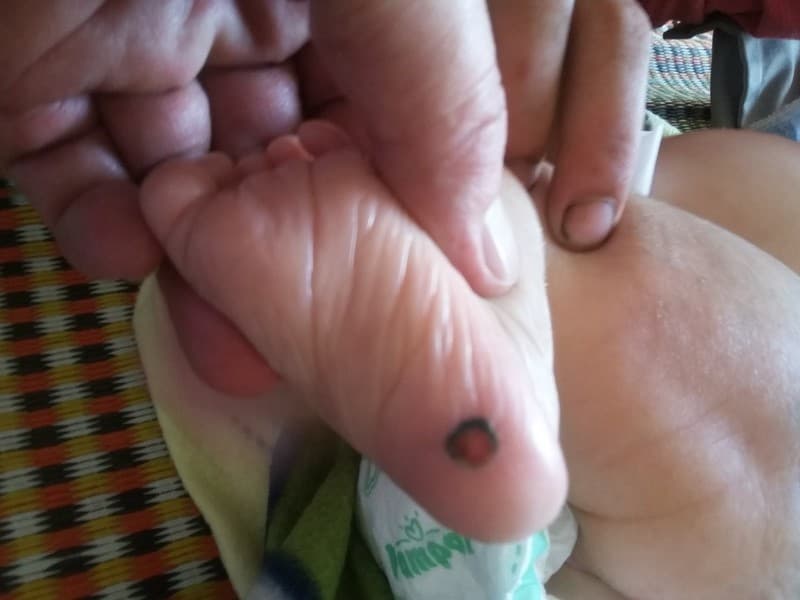 Bé 1 tháng tuổi đã mắc giang mai... nguyên nhân, cách phòng ngừa?