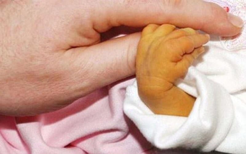 Vàng da ở trẻ sơ sinh: Cần chú ý dấu hiệu vàng da bệnh lý