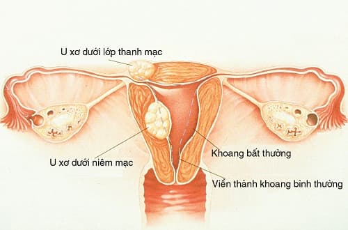 Sảy thai liên tiếp: những điều cần biết