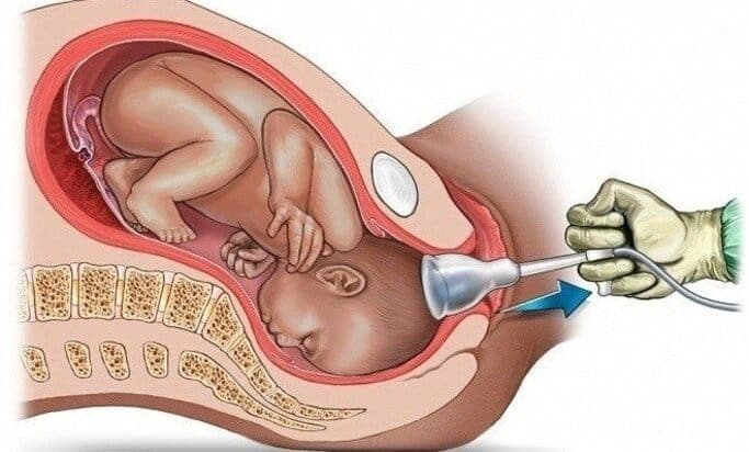 Sử dụng giác hút khi sinh - Những rủi ro mẹ bầu có thể gặp phải!