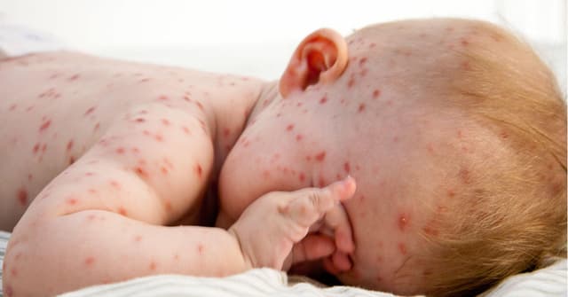 Trang bị kiến thức về các bệnh thường gặp vào mùa hè ở trẻ nhỏ