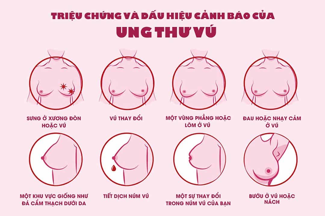 Phụ nữ dậy thì sớm và mãn kinh muộn có nguy cơ mắc bệnh ung thư vú cao hơn người khác