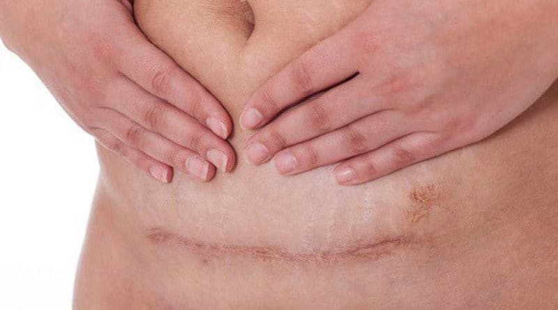 Vết mổ sau sinh bị nhiễm trùng: Nguyên nhân, dấu hiệu và cách điều trị