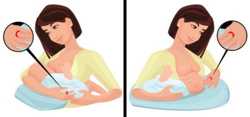 Tắc tia sữa: Nguyên nhân, triệu chứng, cách điều trị và phòng bệnh