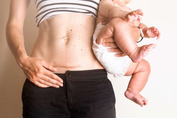 Giải đáp: Làm thế nào khi vết mổ sau sinh bị cứng, đau, ngứa?