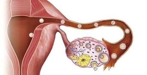 3 cách phát hiện sớm nhất ung thư buồng trứng